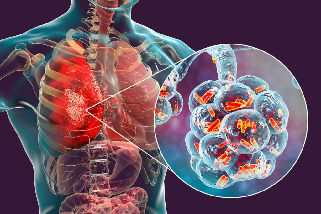 3D illustration showing rod-shaped bacteria inside alveoli of the lung